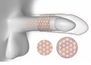 Aumento do pênis em volume