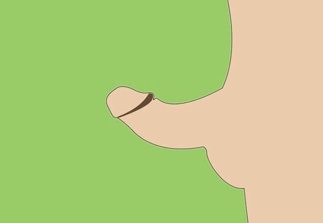 curvatura do pênis como indicação para aumento cirúrgico